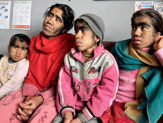 Familia 'hombre lobo'