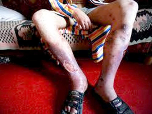 'Krokodil', la droga que devora la piel y tiene en alerta al mundo