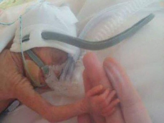 Bebé prematuro sobrevive con tan solo 534 gramos