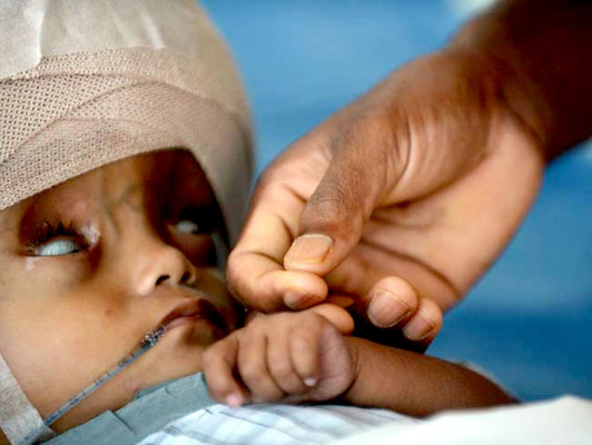 Niña de 15 meses con hidrocefalia es operada exitosamente