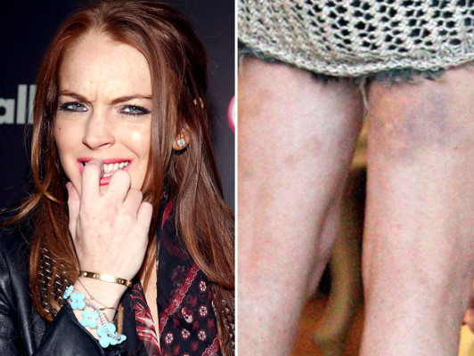 ¿Qué le pasó a Lindsay Lohan en las piernas?