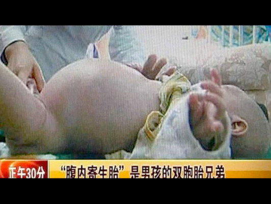 Descubren feto en estómago de bebé de 2 años