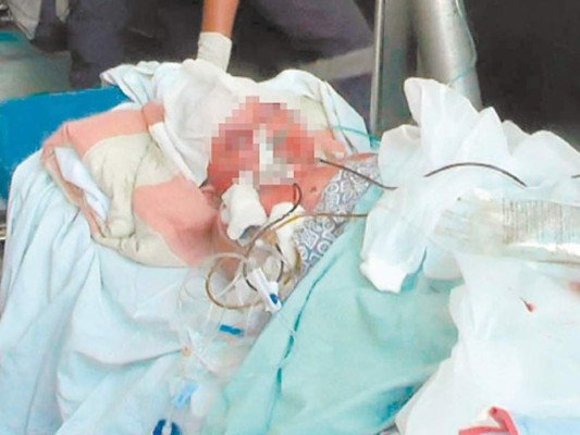 Siete menores quemados reporta el Hospital Escuela