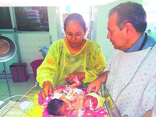 Madre hondureña pide ayuda para siamesas