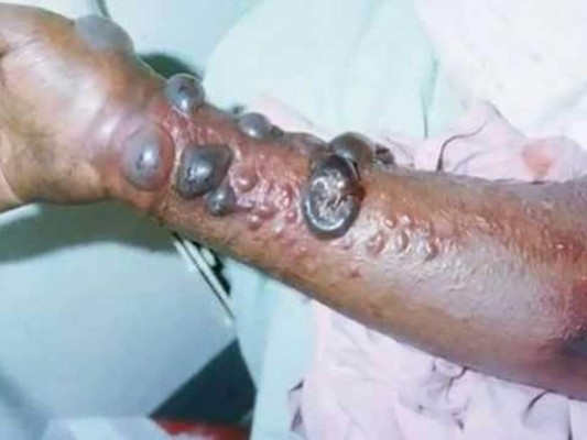 OMS alerta sobre el virus del Ébola