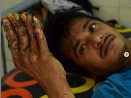 Así es Abul Bajandar, el 'hombre-árbol' bangladesí que pide ser amputado