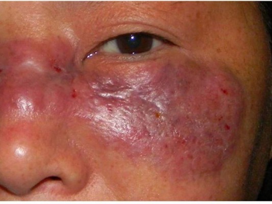 Expertos: 'Hongo negro aumentaría la mortalidad en Honduras'