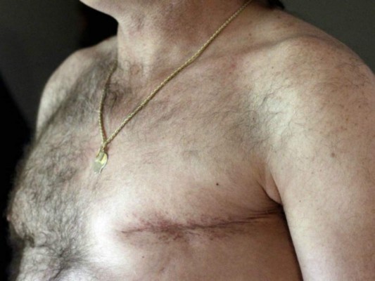 El cáncer de mama también se da en los hombre ¿Cómo identificarlo?