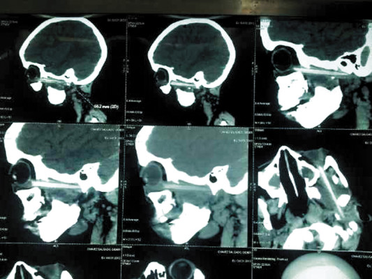 Menor vivió más de un año con una estaca en su ojo