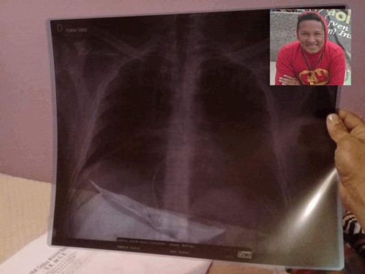 Golpiza a El Chapulín Colorado le dejó siete costillas dañadas