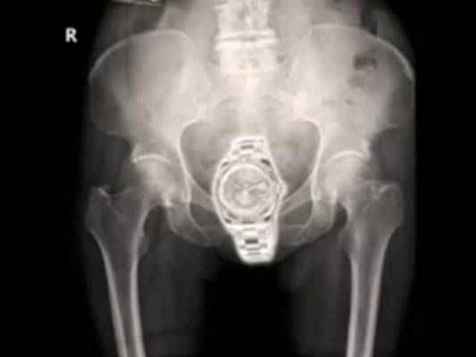 Rolex en la vagina