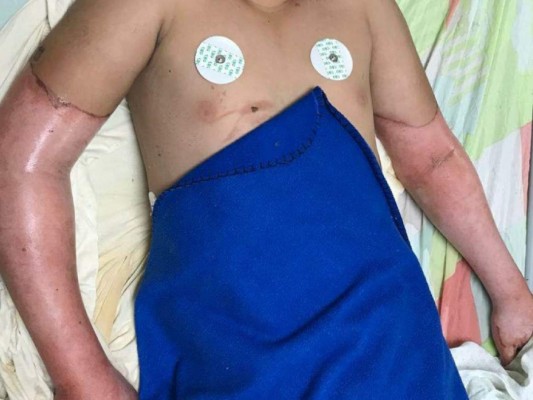 Un menor, primera víctima de pólvora en temporada navideña 2017