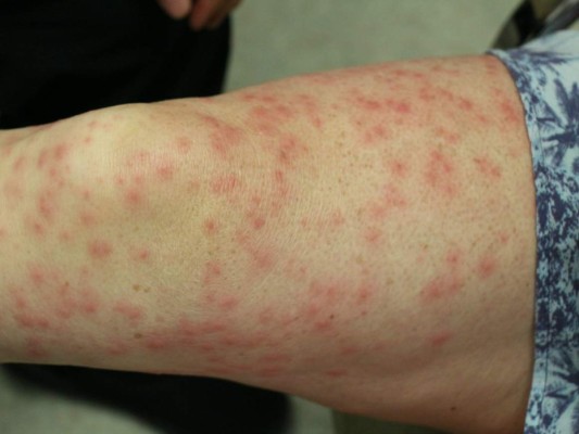 5 trucos caseros para evitar la irritación al depilarte