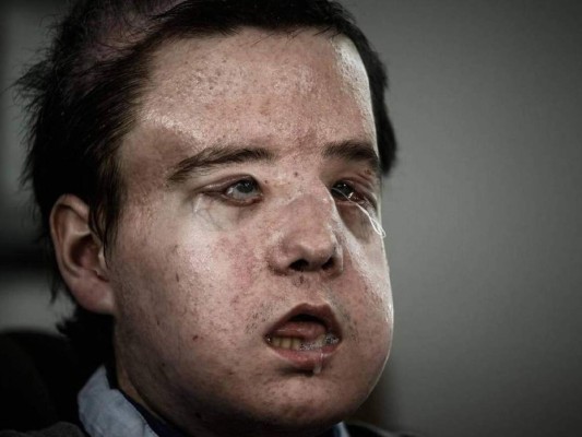 El hombre de las tres caras habla tras un nuevo trasplante