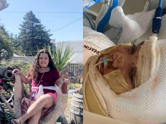 Menor de 13 años sufre brutales quemaduras al realizar peligroso reto de Tik Tok