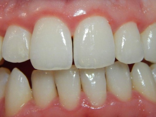 ¿Cómo saber si tengo gingivitis?