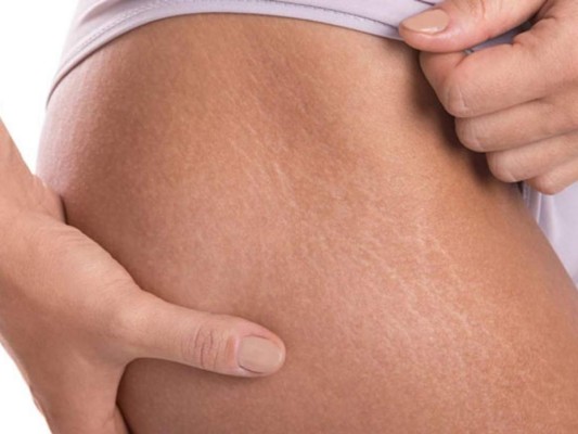 Cinco efectivos remedios caseros para combatir y eliminar estrías