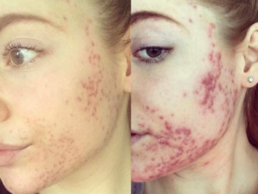 Las redes sociales le ayudaron a superar las burlas que generaba su acné