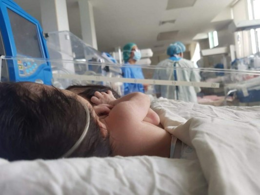 Siamesas no serán separadas en Honduras porque comparten órganos vitales