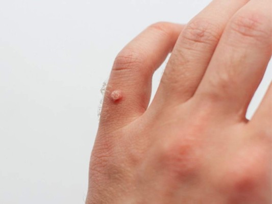 Tres remedios caseros para eliminar las verrugas de la piel