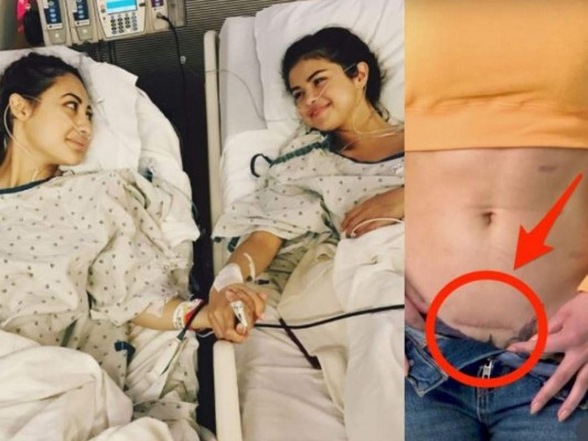 Francia Raisa sufrió depresión tras donarle a Selena Gómez un riñón; así es su cicatriz