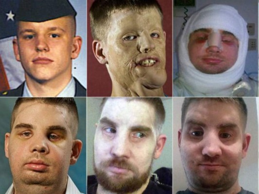 FOTOS: El increíble trasplante de rostro de un soldado