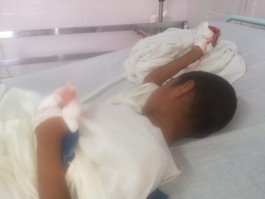 A 36 sube cifra de quemados por la pólvora tras fiestas de Navidad