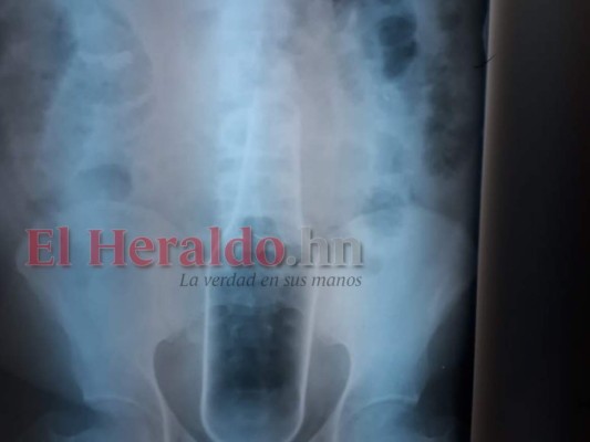 Esta radiografía muestra la botella en el interior del cuerpo del hondureño.