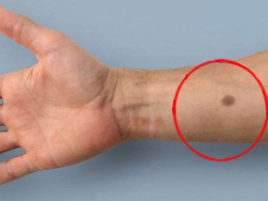 Un lunar artificial podría advertir el cáncer, según un estudio