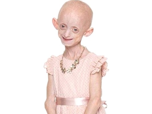 Muere Ashanti Smith, la joven que aparantaba más de 100 años por una rara enfermedad&nbsp;&nbsp;