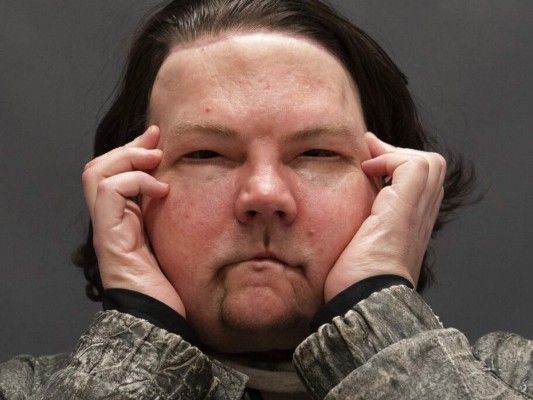 EEUU: Hombre recibe trasplante de cara y ambas manos&nbsp;