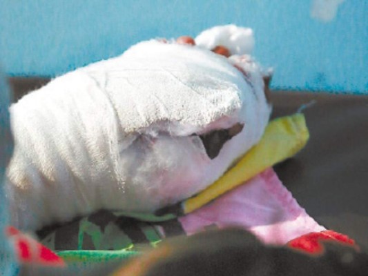 Potente mortero cercena tres dedos a menor de 11 años en Siguatepeque