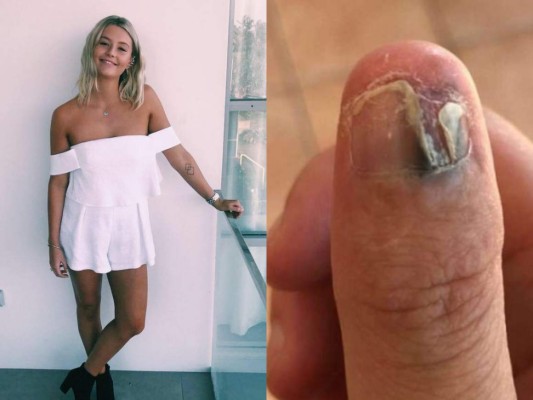 Joven sufre cáncer y amputación del pulgar por comerse las uñas