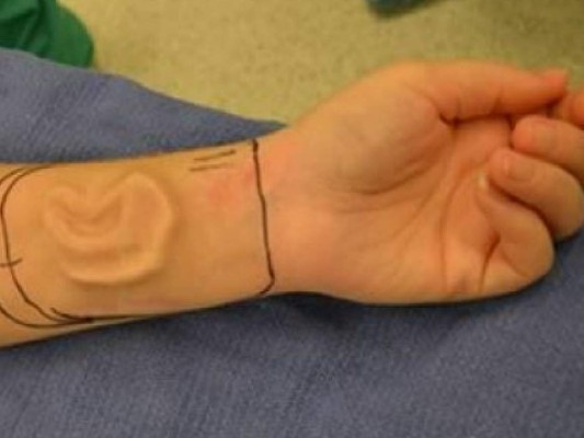 Hombre pierde la oreja y la recupera en su brazo