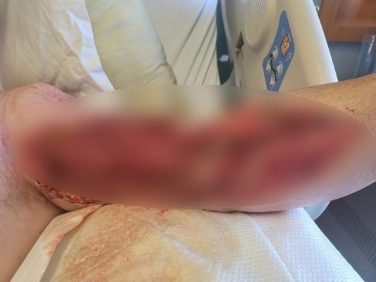 Desgarrador: así quedó el brazo de un trabajador de 'Rust' tras mordedura de araña venenosa