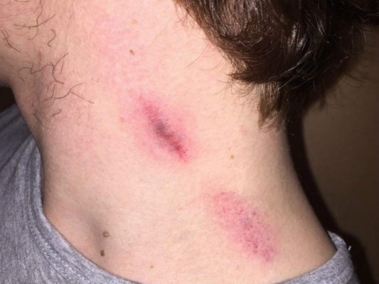 Un chupetón en el cuello mata a joven de 17 años