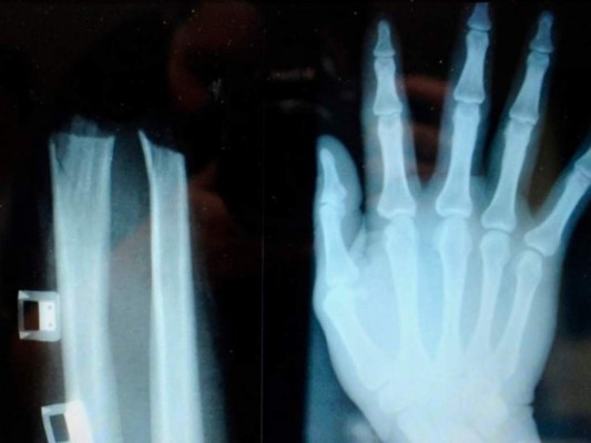 Dos años de cárcel para eslovena que se cortó la mano para cobrar el seguro