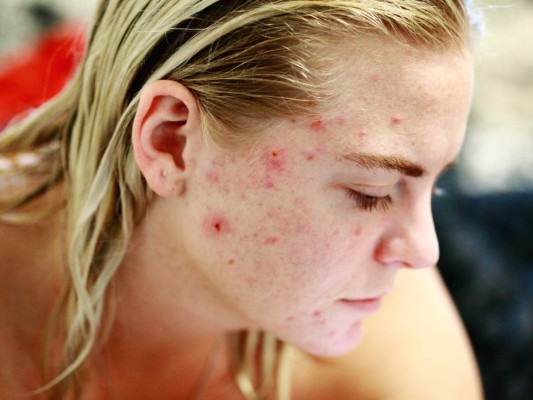 ¿Los probióticos pueden prevenir o tratar el acné?  