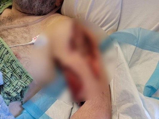 Desgarrador: así quedó el brazo de un trabajador de 'Rust' tras mordedura de araña venenosa