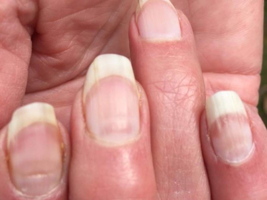 'Uñas covid', conoce cuáles son los cambios que indican una infección pasada&nbsp;&nbsp;