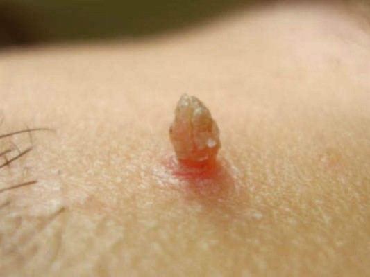 Remedios caseros para eliminar las verrugas