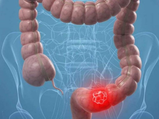 ¿Qué es el cáncer de ano y cuáles son sus síntomas?&nbsp;&nbsp;