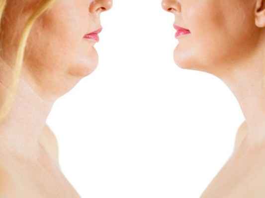 ¿Cómo reducir la papada? Prueba estos eficaces ejercicios y remedios caseros