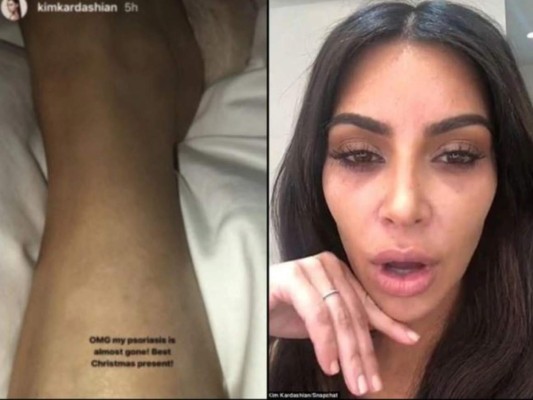 Kim Kardashian revela que la psoriasis que sufría en las piernas ya afectó su rostro