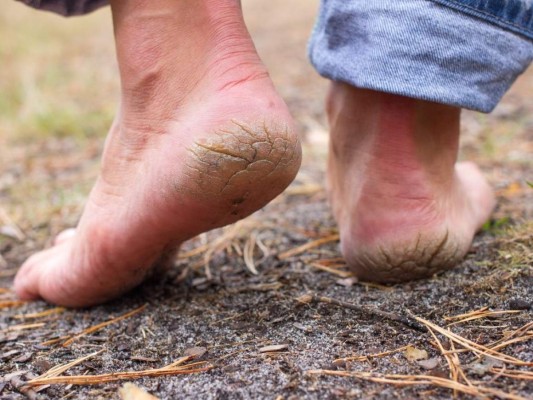 El cuidado de los pies es importante ya que es uno de las partes del cuerpo más utilizadas. Foto: Canva