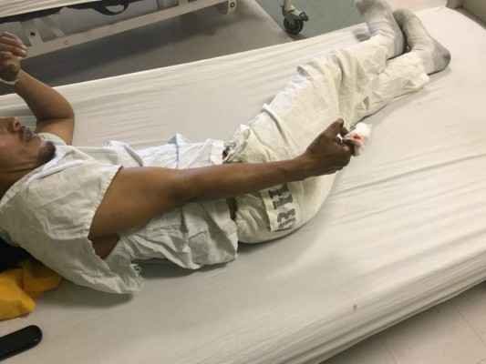 19 personas quemadas ingresaron al Hospital Escuela Universitario (HEU) por manipular pólvora en Navidad