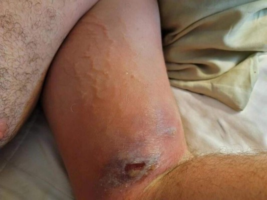 Desgarrador: así quedó el brazo de un trabajador de 'Rust' tras mordedura de araña venenosa
