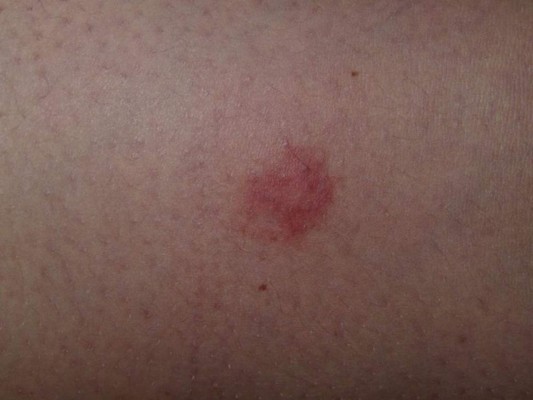 10 señales de advertencia para detectar el cáncer de piel