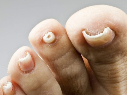 ¿Cómo eliminar los hongos de las uñas con remedios naturales?