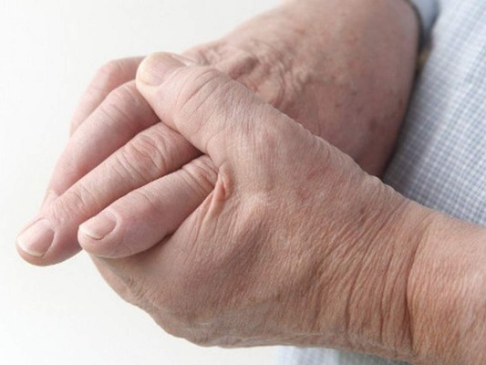 Ocho síntomas de la artritis reumatoide que no debe ignorar